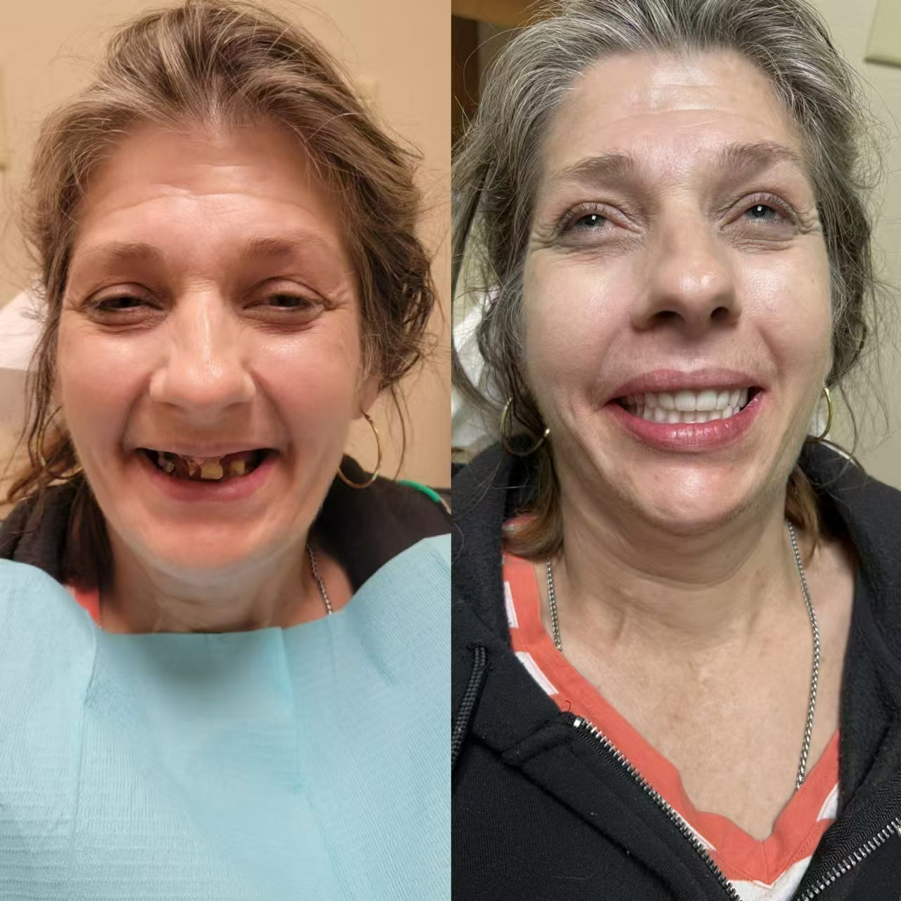 Easy DentureTM kerámia kompozit szilikon állítható univerzális fogpótlás