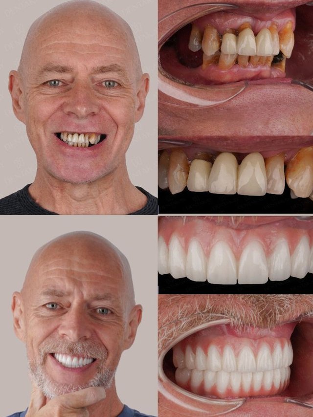 【Klasa medyczna】Zestaw protez opatentowany w USA